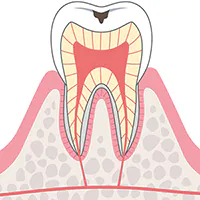 C1:エナメル質のむし歯