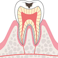C2:象牙質のむし歯