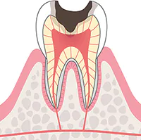 C3:歯の神経に達したむし歯