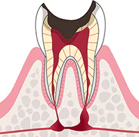C4:歯根にまで達したむし歯