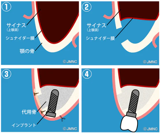 サイナスリフト