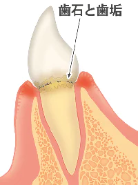 歯肉炎