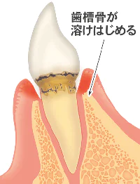 軽度歯周炎