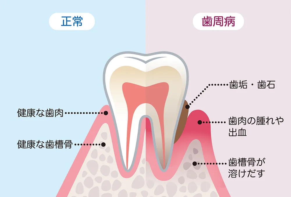 なぜ歯周病が抜歯につながるのか